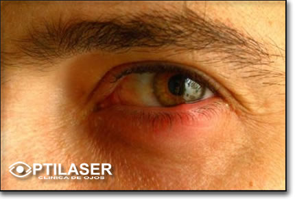 Clinica de ojos Optilaser - Orzuelo